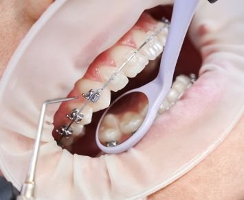 Dental Braces in Dubai