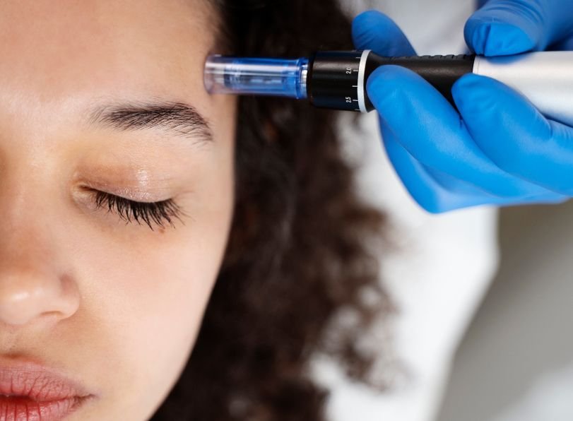 Microneedling