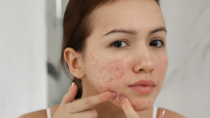 acne scar treatment in dubai