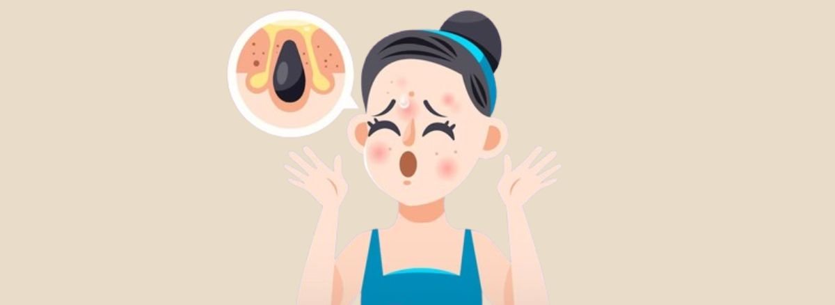 Korean Acne Scar Treatments