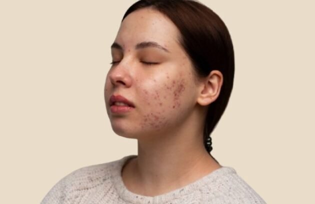 Acne Scars Treatment