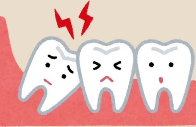 Wisdom Teeth Removal