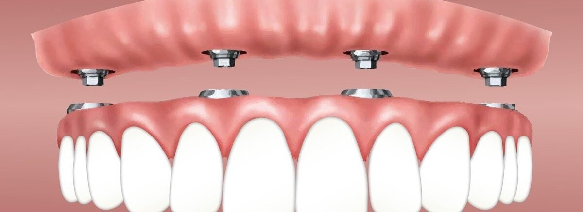 Dental Implants in Dubai – Cost, Procedure & Recovery Guide – Lakeshore Aesthetic & Wellness Center, Dubai Dental Implants in Dubai – Cost, Procedure & Recovery Guide – Lakeshore Clinic Qusais Dubai