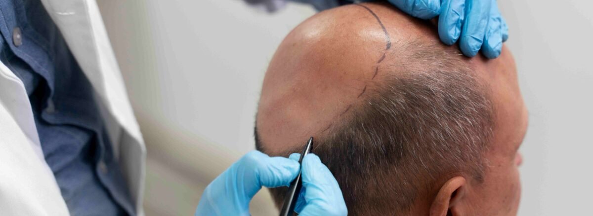 Best Hair transplantation in Dubai at Lakeshore with advanced techniques for natural hair restoration and expert care results