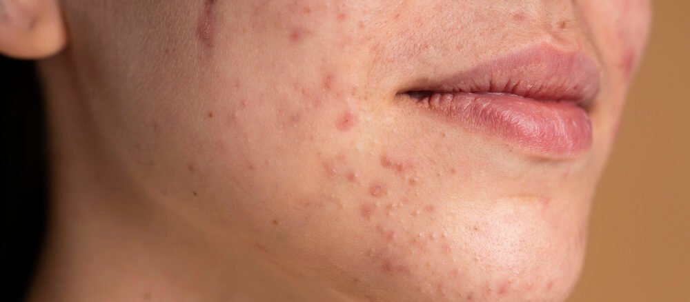 What Causes Acne Scars and How Can They Be Treated Acne Scar Treatment in Dubai? – Lakeshore Aesthetic & Wellness Center, Dubai Acne Scar Treatment in Dubai showing advanced laser and microneedling procedures for smoother, healthier skin