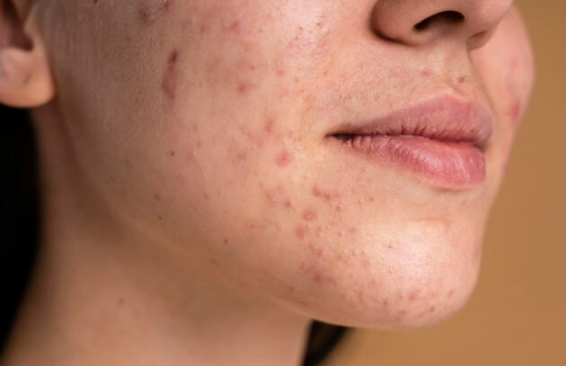 Acne Scar Treatment in Dubai showing advanced laser and microneedling procedures for smoother, healthier skin