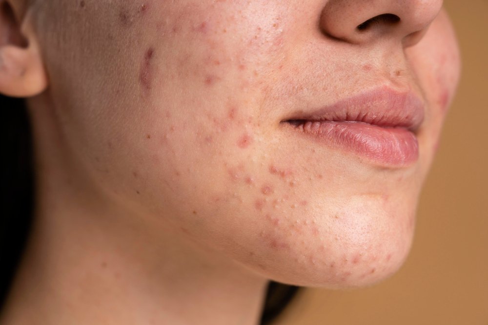 Acne Scar Treatment in Dubai showing advanced laser and microneedling procedures for smoother, healthier skin