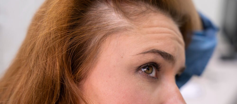 Common causes of hair loss in men and women, including genetic hair loss, hormonal changes, stress, nutritional deficiencies, and scalp conditions.