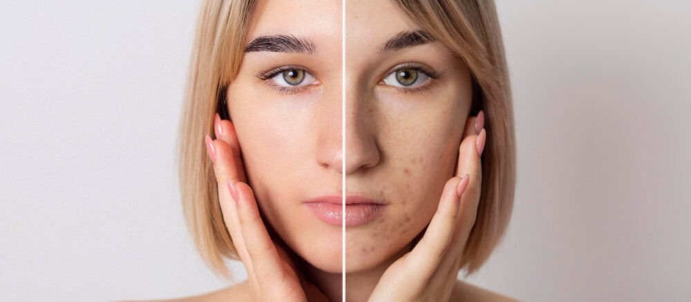 Dermatologist explaining acne scar treatment options in Dubai for smoother skin.