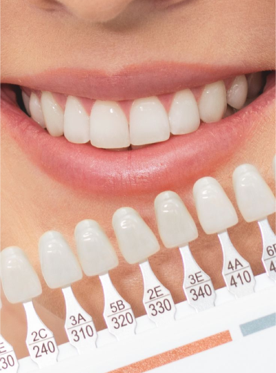 Best-Veneers