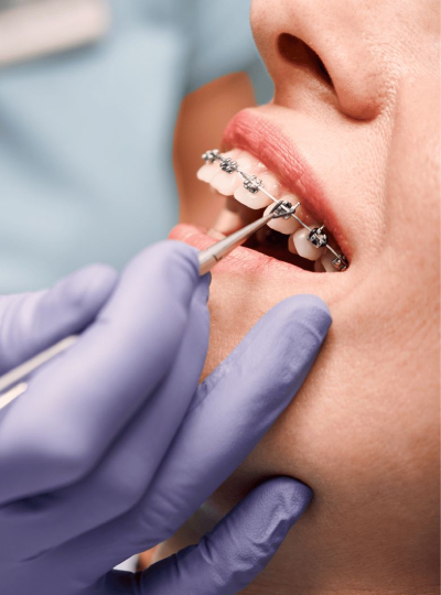 Dental-Braces