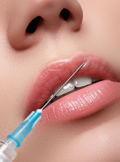 Lip-Fillers